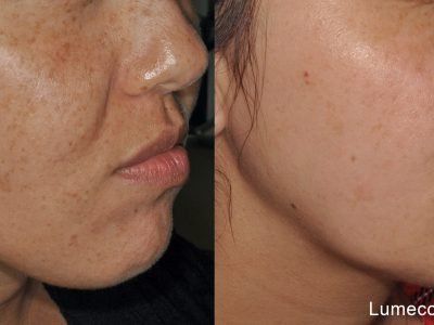 lumecca-before-after-dr-v-ross-preview-3